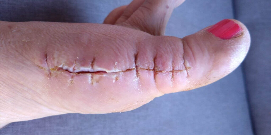 [Alt-teksti: Sormessa oleva noin 3cm pituinen tikattu haava.]